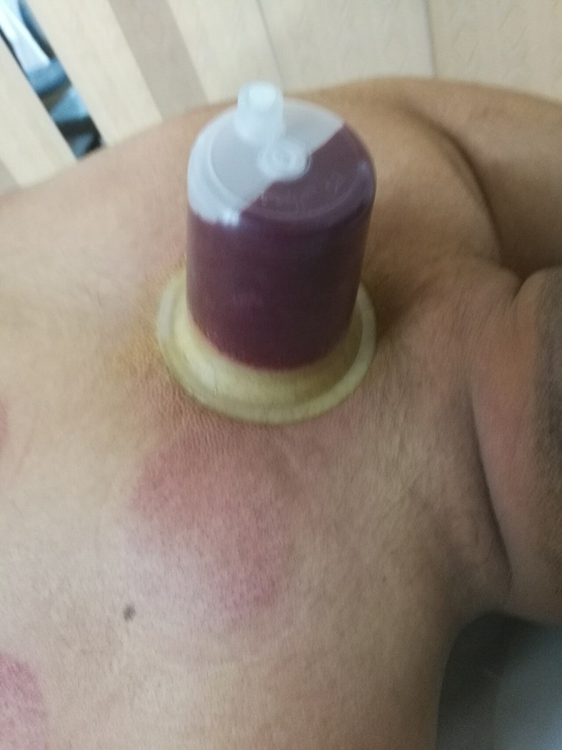 Cupping hijama dry wet therapy diagram